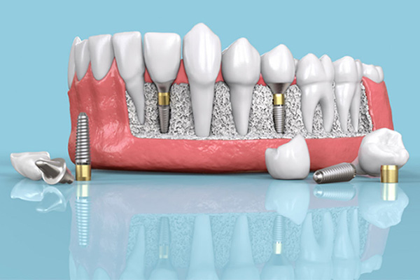 Dental Implants